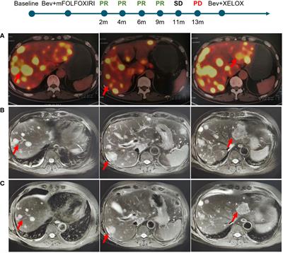 RNF43 is associated with genomic features and clinical outcome in BRAF mutant colorectal cancer